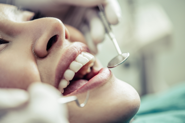 Dental Bonding Services