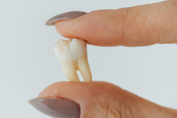 Dental Extractions Services