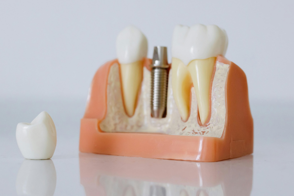 Dental Crowns Services